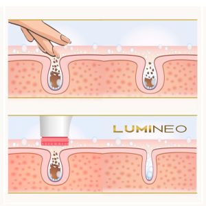ЧЕТКА ЗА ЛИЦЕ 4 В 1 - LUMINEO PRO HOME SPA + ГЕЛ ЗА ЧУВСТВИТЕЛНА КОЖА 100 мл - РОЗОВА